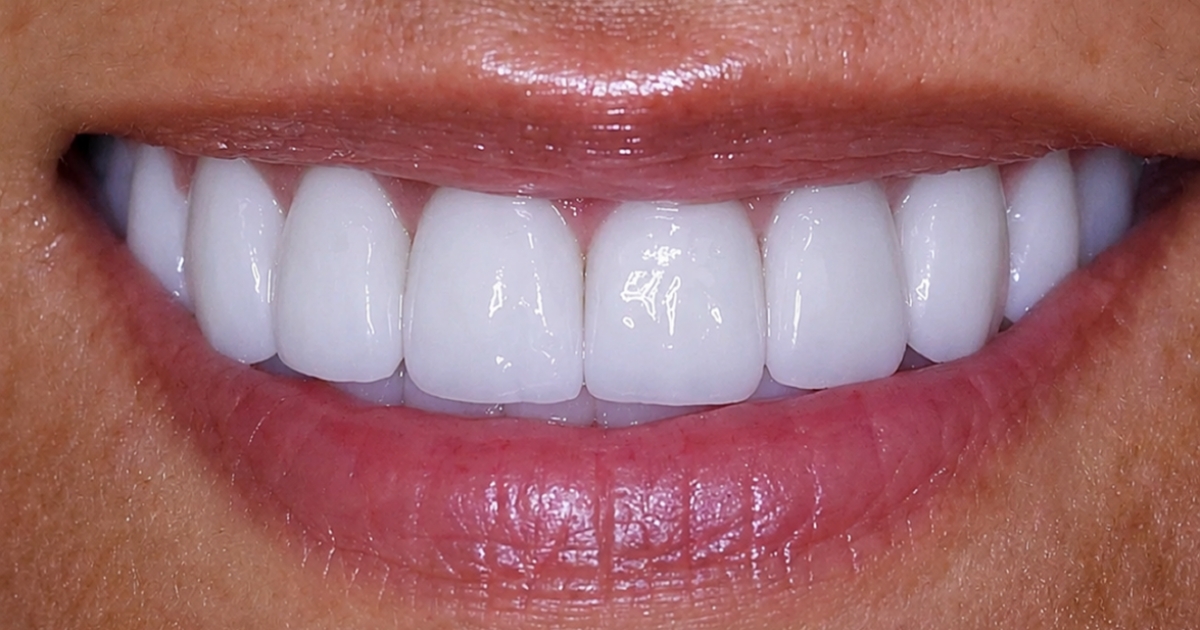 slightly chipped tooth — supporting image 2