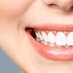 teeth bleaching — featured image