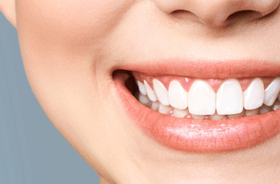 teeth bleaching — featured image