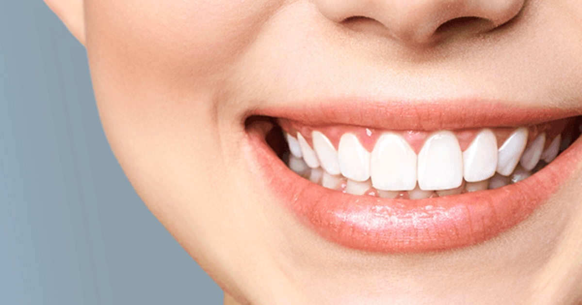 teeth bleaching — featured image