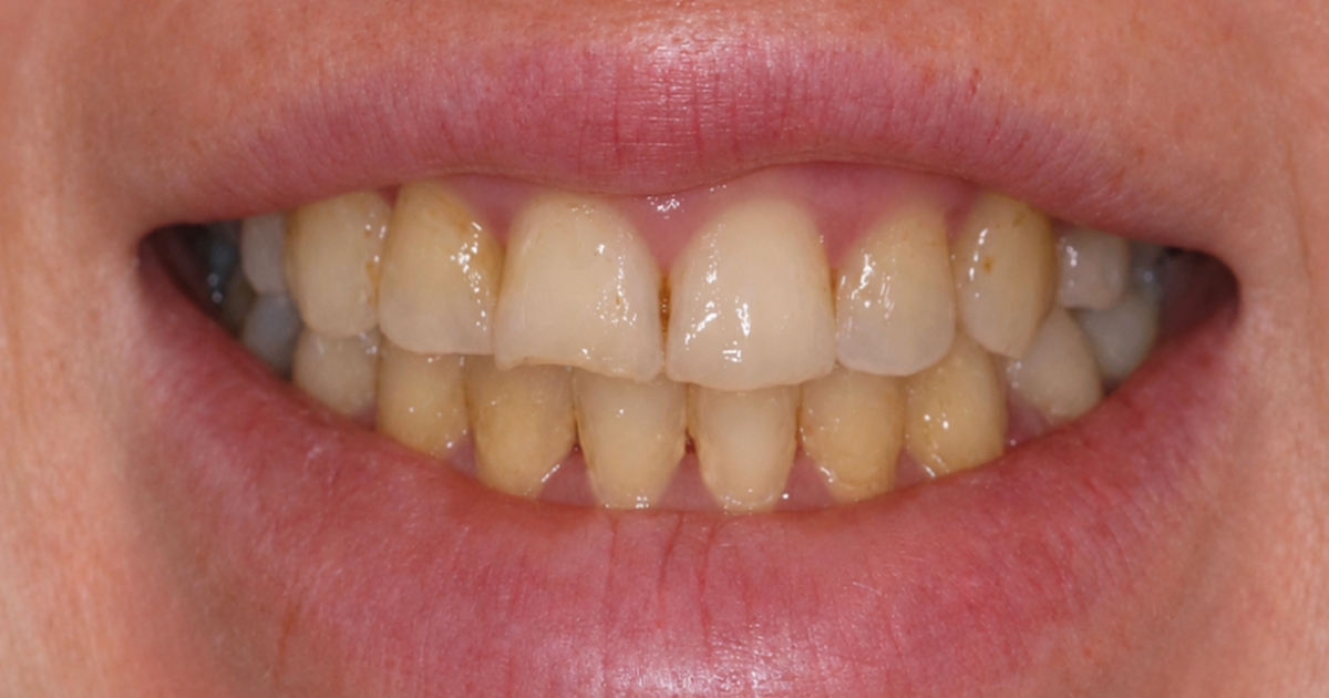 teeth bleaching — supporting image 1