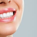 professional teeth whitening — featured image