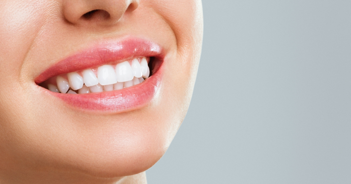professional teeth whitening — featured image