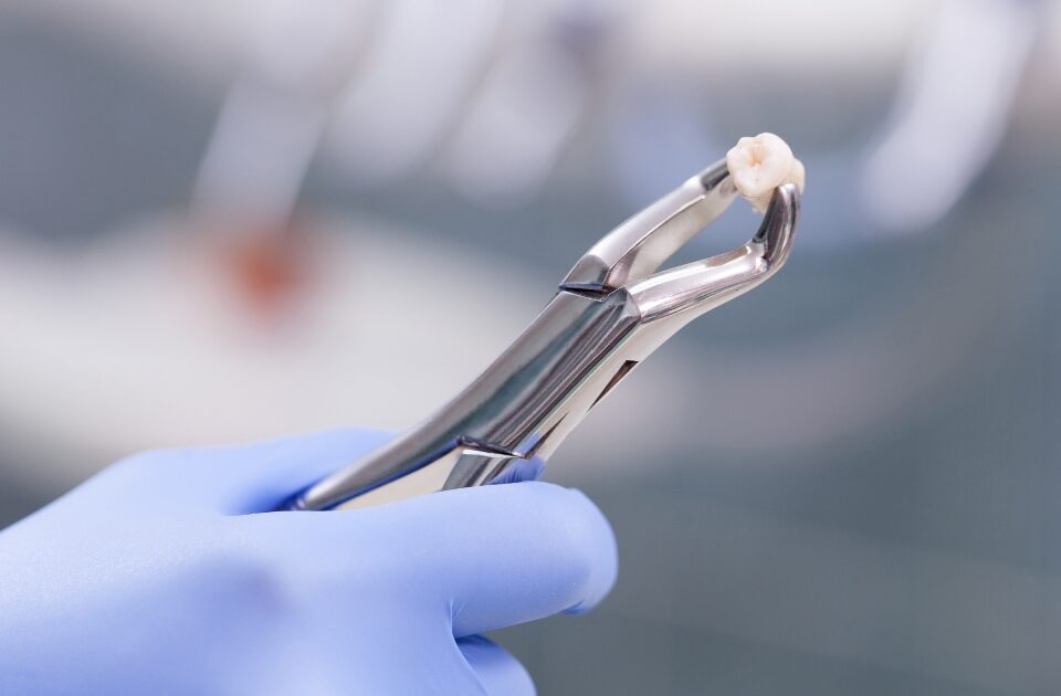 when can i eat solid food after tooth extraction — featured image