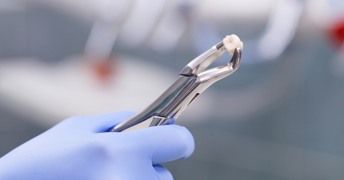 when can i eat solid food after tooth extraction — featured image