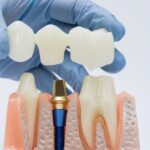 what is a dental bridge — featured image
