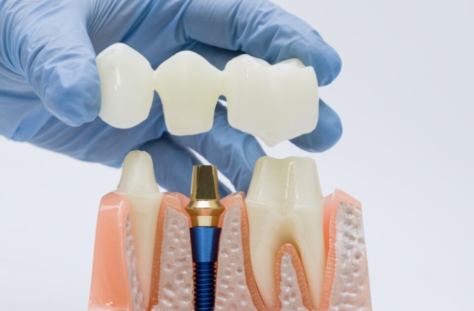 what is a dental bridge — featured image