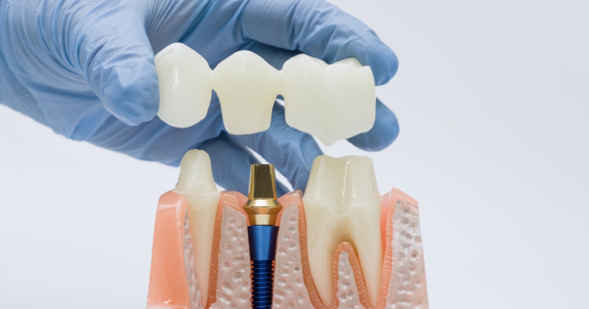what is a dental bridge — featured image