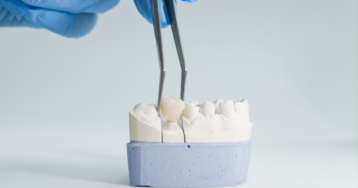 crowns for teeth — featured image