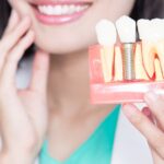 permanent dental implants — featured image