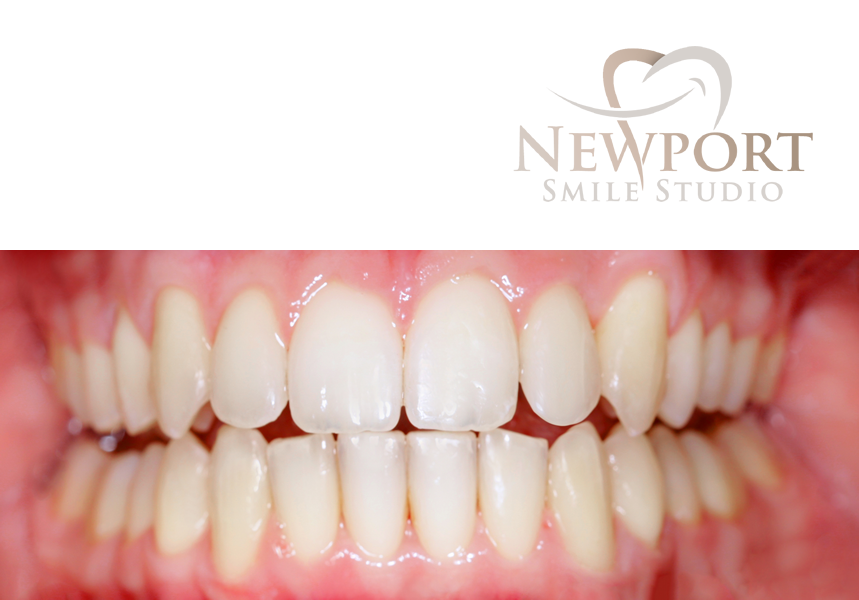 average cost of invisalign — supporting image 2