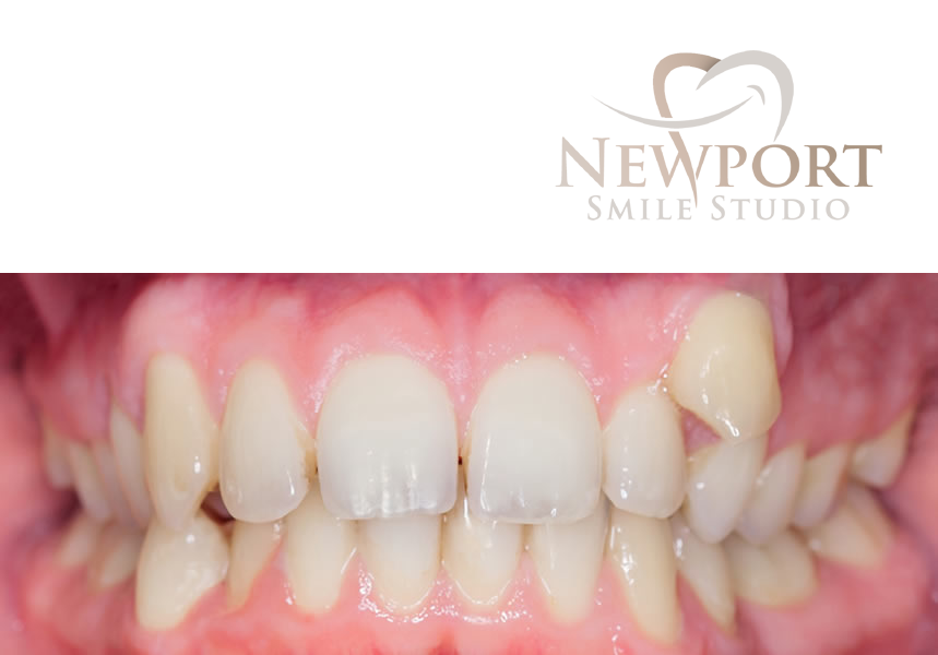 average cost of invisalign — supporting image 1