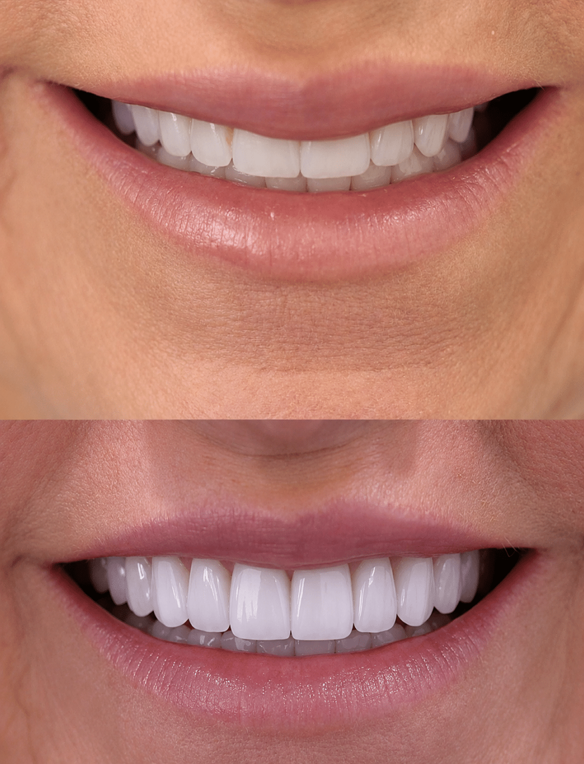 are veneers permanent — supporting image 1