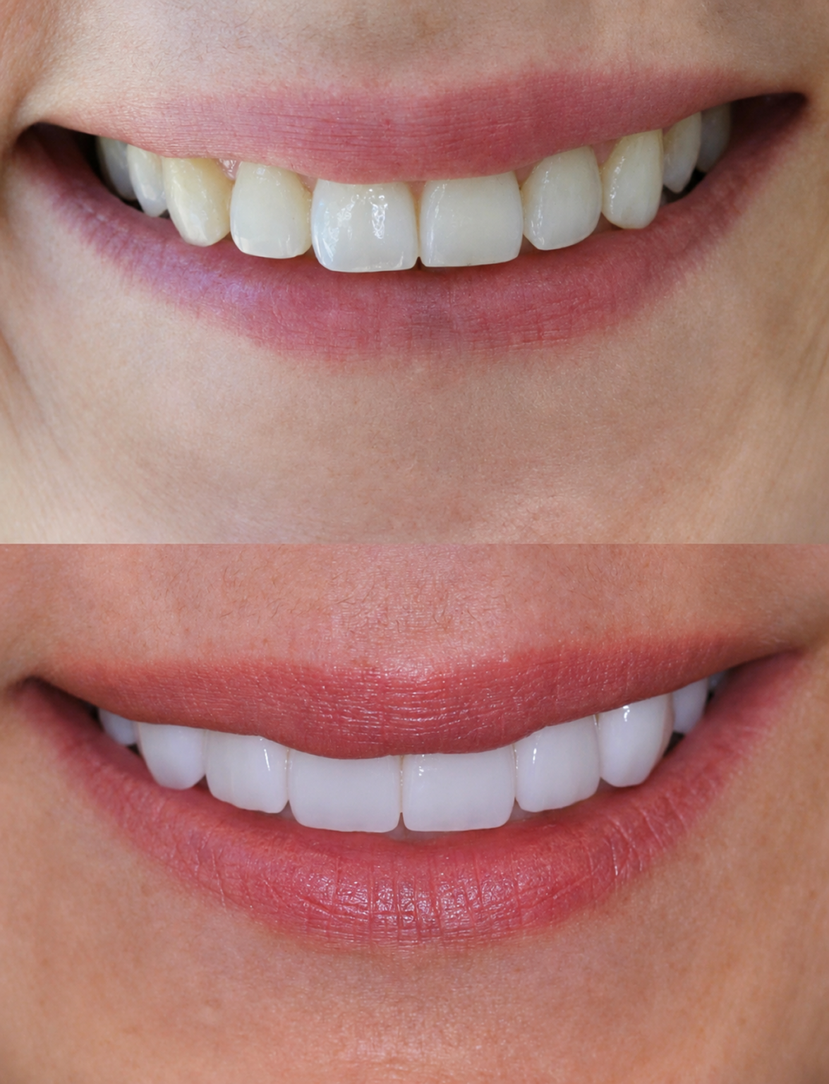 are veneers permanent — supporting image 2