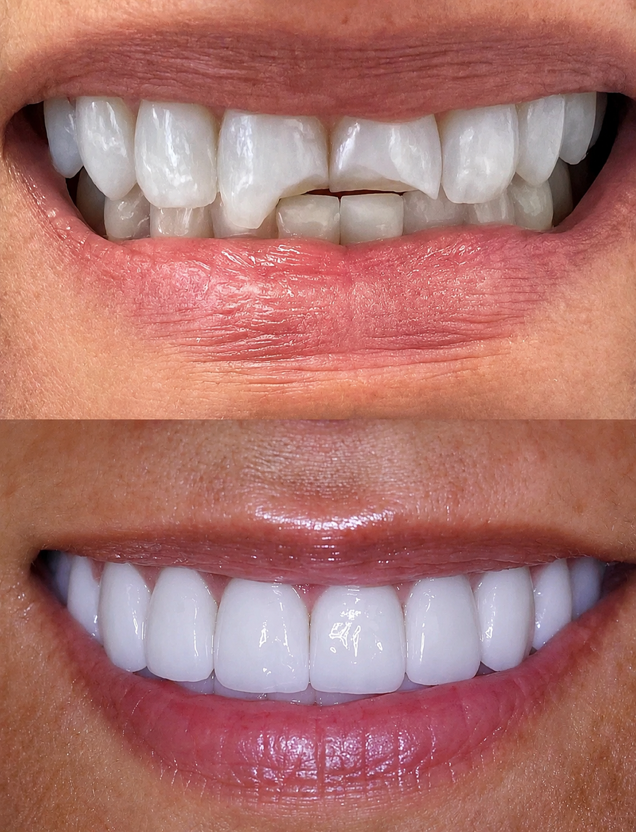 how much does it cost to fix a chipped tooth — supporting image 1