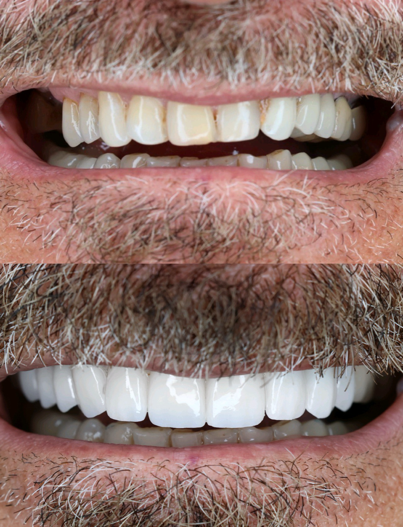 permanent dental implants — supporting image 1