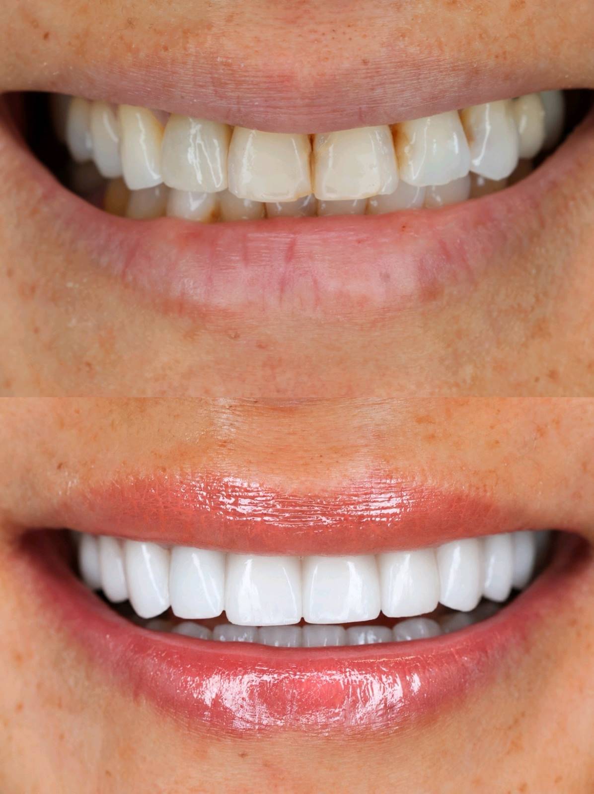 professional teeth whitening — supporting image 1