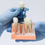 affordable dental implants — featured image